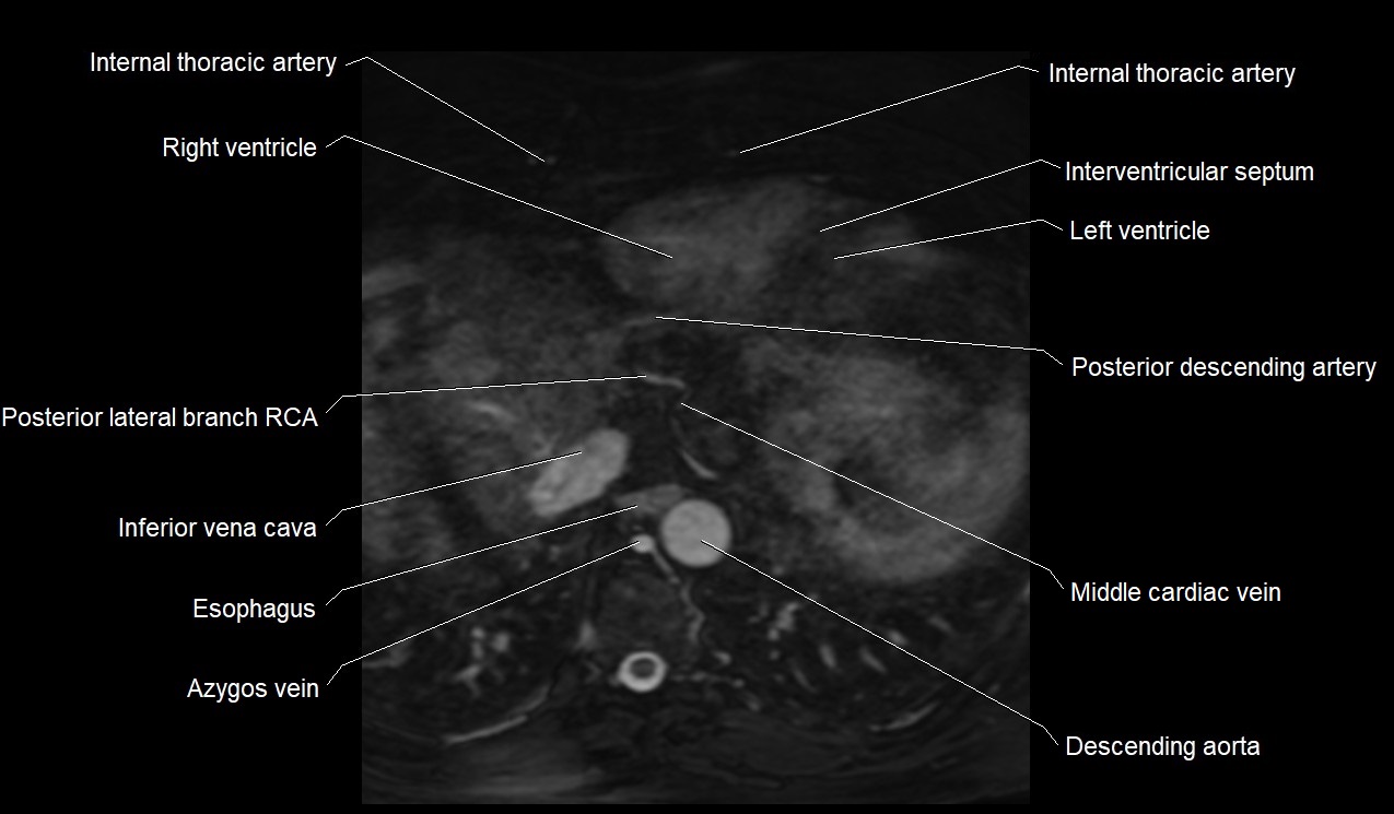 MRI heart coronary arteries and coronary veins anatomy axial image 40.jpg